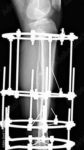 Tablou pe pânză x-ray of the tibia with a fracture of the tibia fixed by an external fixation de
