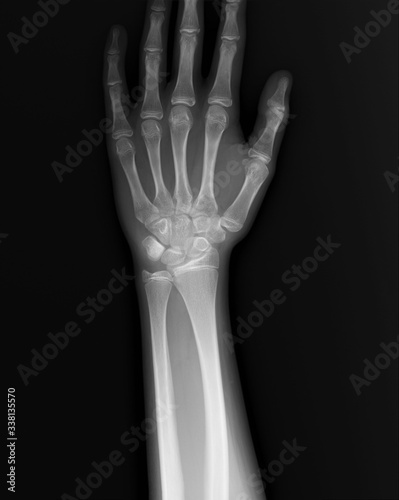 x-ray of the bones of the hand and wrist joint