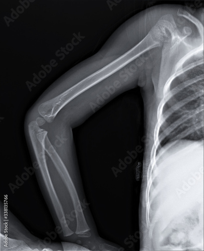 x-ray of the forearm and shoulder bones with the elbow joint