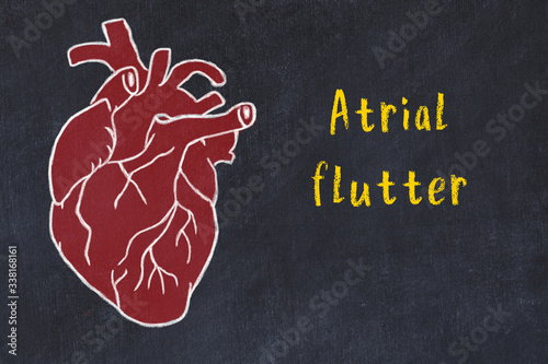 Learning cardio system concept. Chalk drawing of human heart and inscription Atrial flutter photo