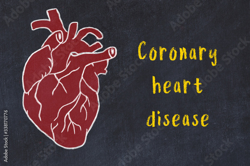 Chalk sketch of human heart on black desc and inscription Coronary heart disease photo