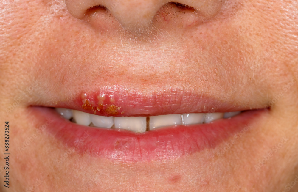 Fototapeta premium Oral herpes simplex virus infection
