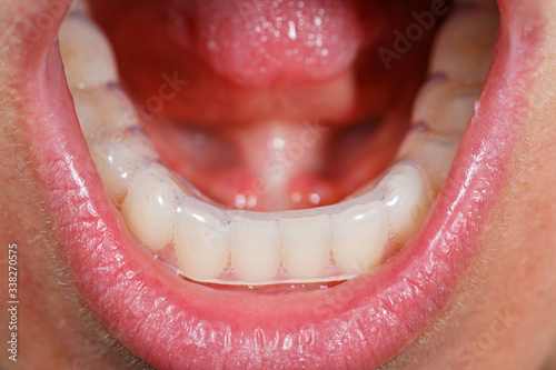 Placing a bite plate in mouth to protect teeth at night from grinding