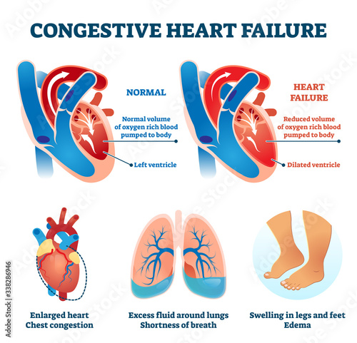 Congestive heart failure vector illustration. Labeled medical compare scheme