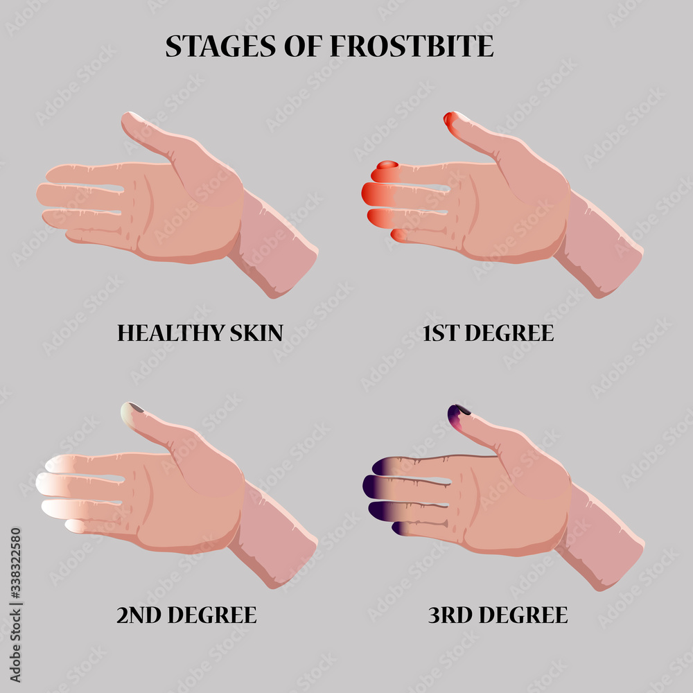 Stages Of Frostbite