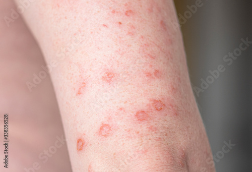Close-up body with allergic rash  eczema on hands  skin with red bumps and blisters 