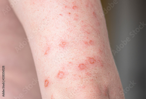 Quadro su tela Close-up body with allergic rash, eczema on hands, skin with red bumps and blist