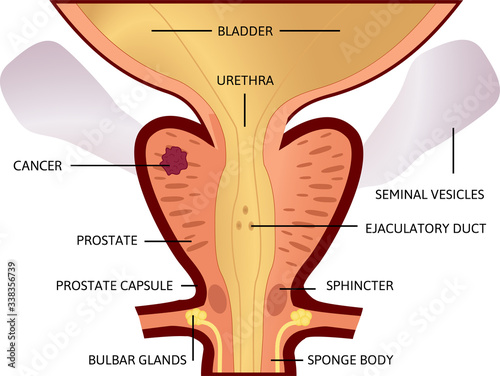 first stage of prostate cancer. The tumor is small and located in prostate.