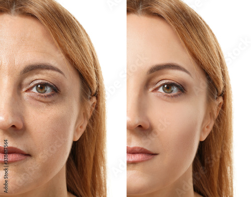 Woman before and after plas...