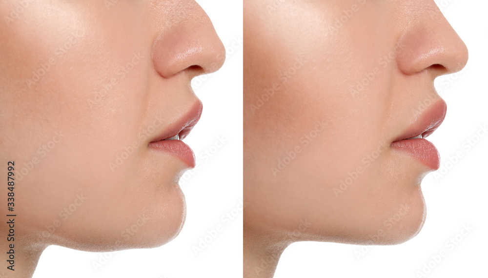 Fototapeta premium Kobieta przed i po operacji plastycznej na białym tle