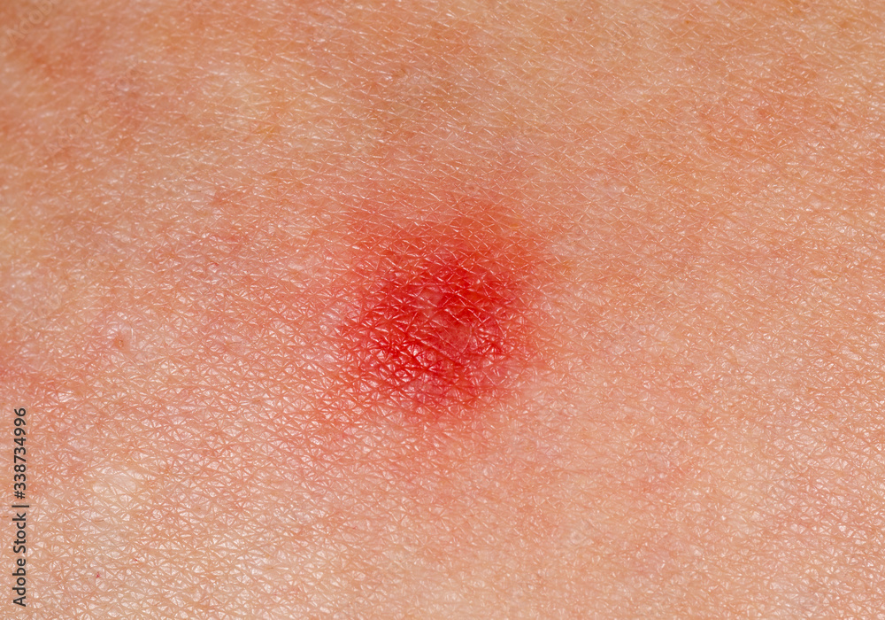 Red patch on human skin