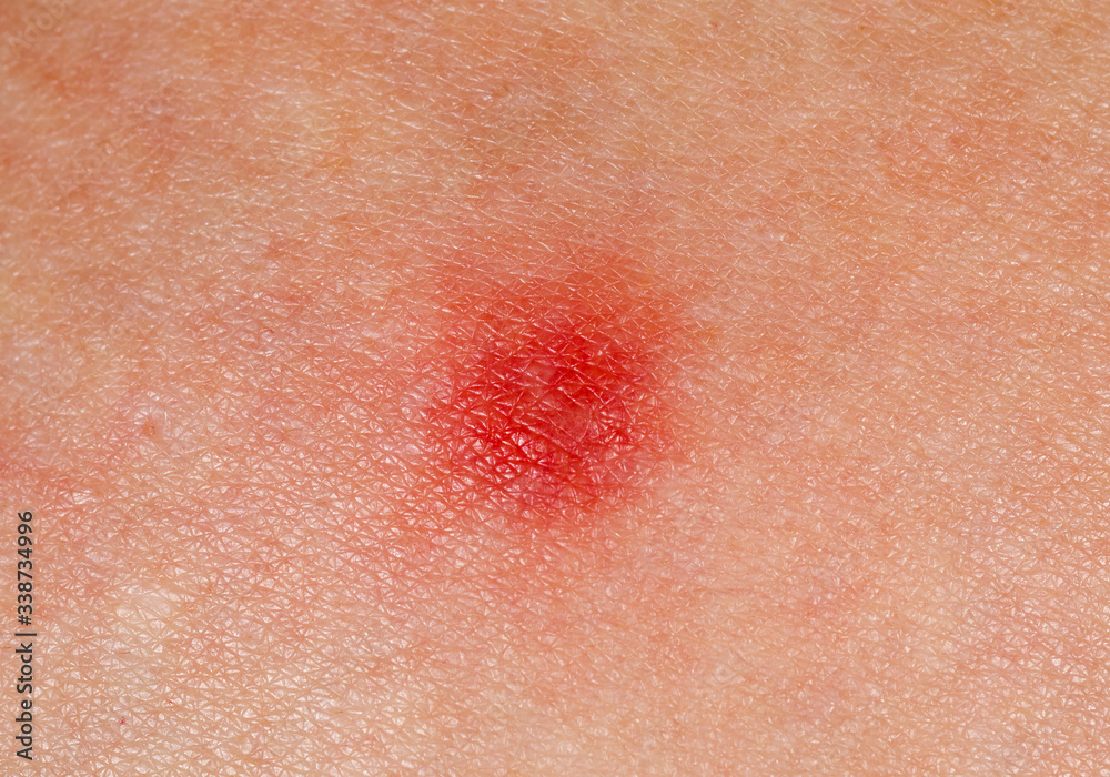 Fototapeta premium Red patch on human skin