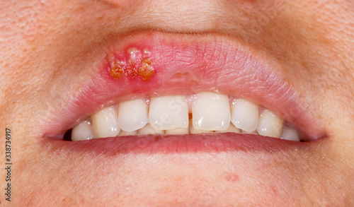 Oral herpes simplex virus infection photo