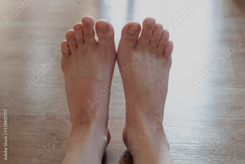 female legs with the disease