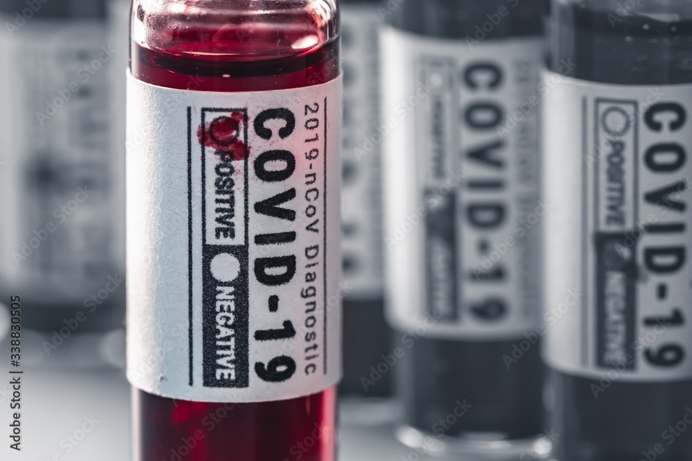 Virus disease lab covid-19 sample, concept test. Virus disease lab covid-19 sample, concept test.