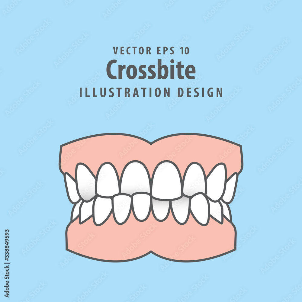 Dental crossbite teeth illustration vector design on blue background. Dental care concept. Dental crossbite teeth illustration vector design on blue background. Dental care concept.