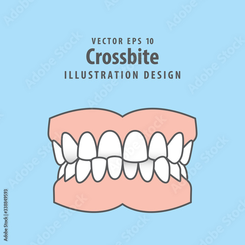 Dental crossbite teeth illustration vector design on blue background. Dental care concept.
