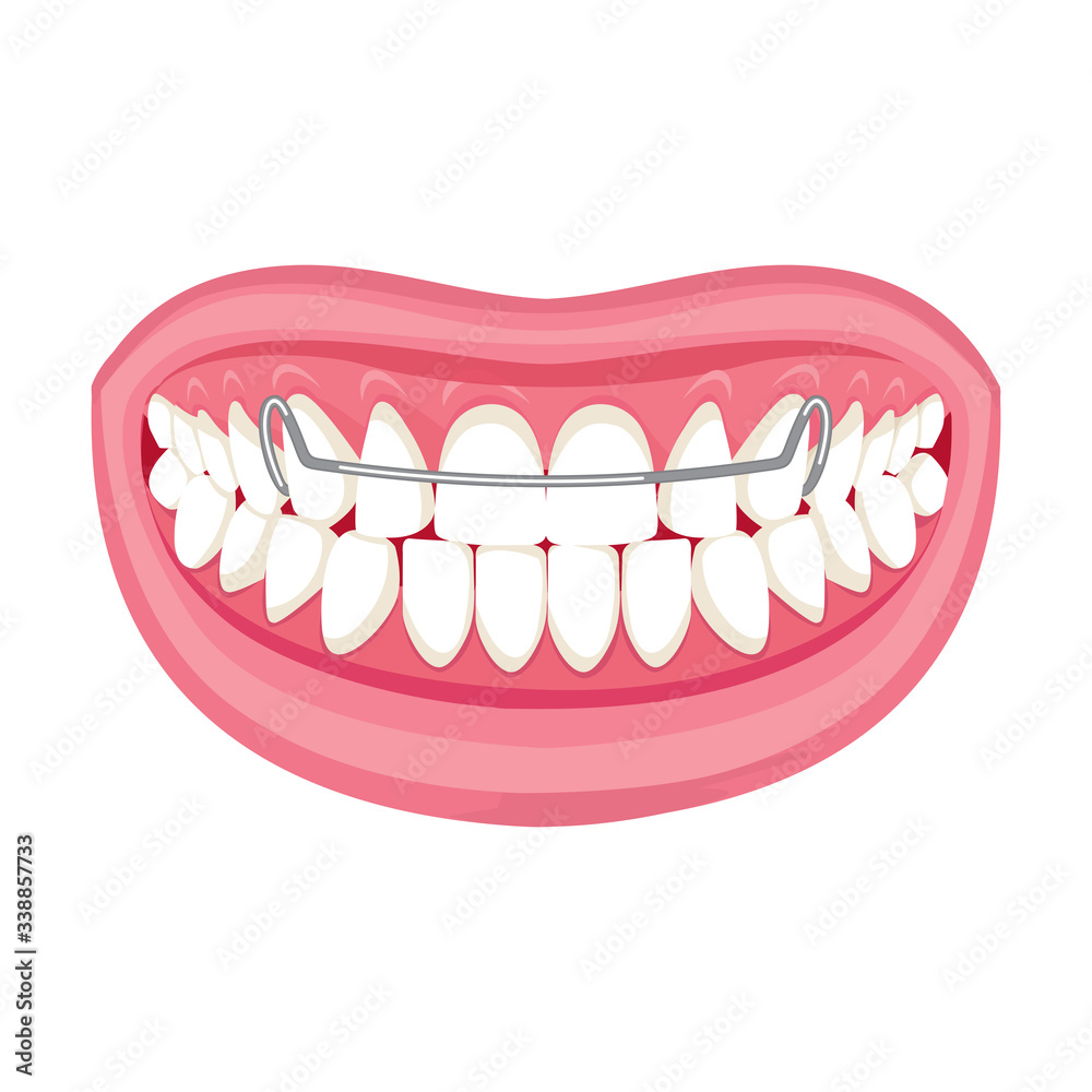 Obraz premium Braces on teeth. pink lips white teeth. White background. 