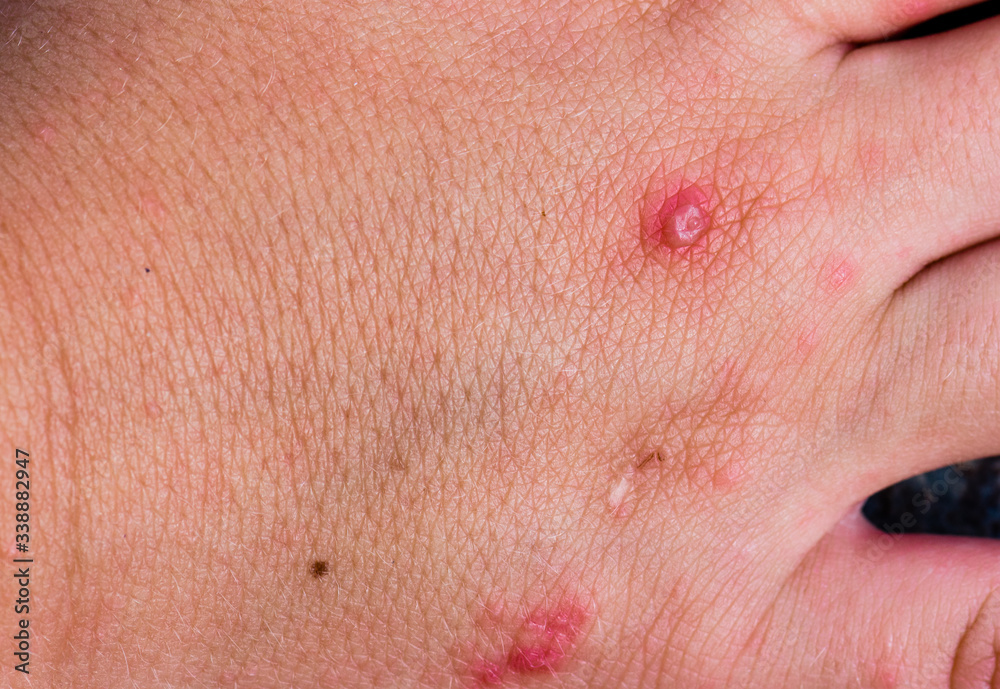 Hand, foot, and mouth disease rash on child hand.