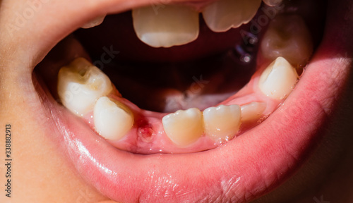 A wound after freshly lost baby tooth.