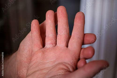 Very dry hands touching, peel due to washing alcohol on Covid19 situation. Horizontal close up of the inside of a very sore dry cracked male hand with flakey skin