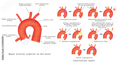 Coarctation repair. Coarctation of Aorta, congenital defect of the aorta (narrowing of the aortic arch). Major surgical aortic coarctation repair techniques. photo