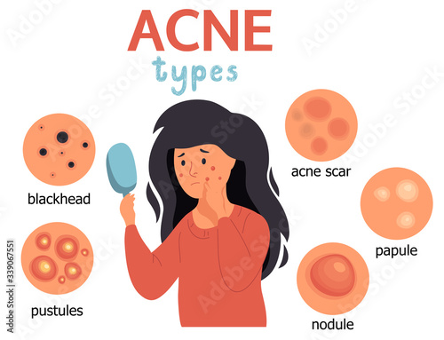 Acne infographic. Unhappy girl struggling with acne,pimples. Skin face irritation problem.