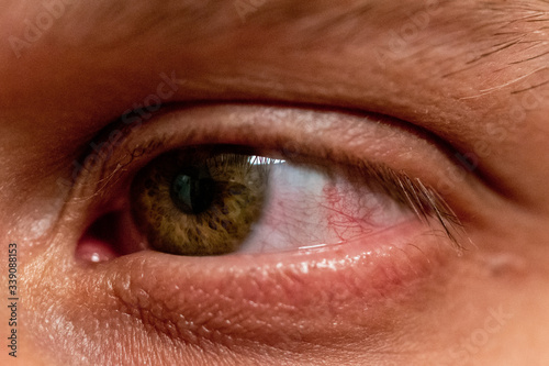 Macro of conjunctivitis red eye.