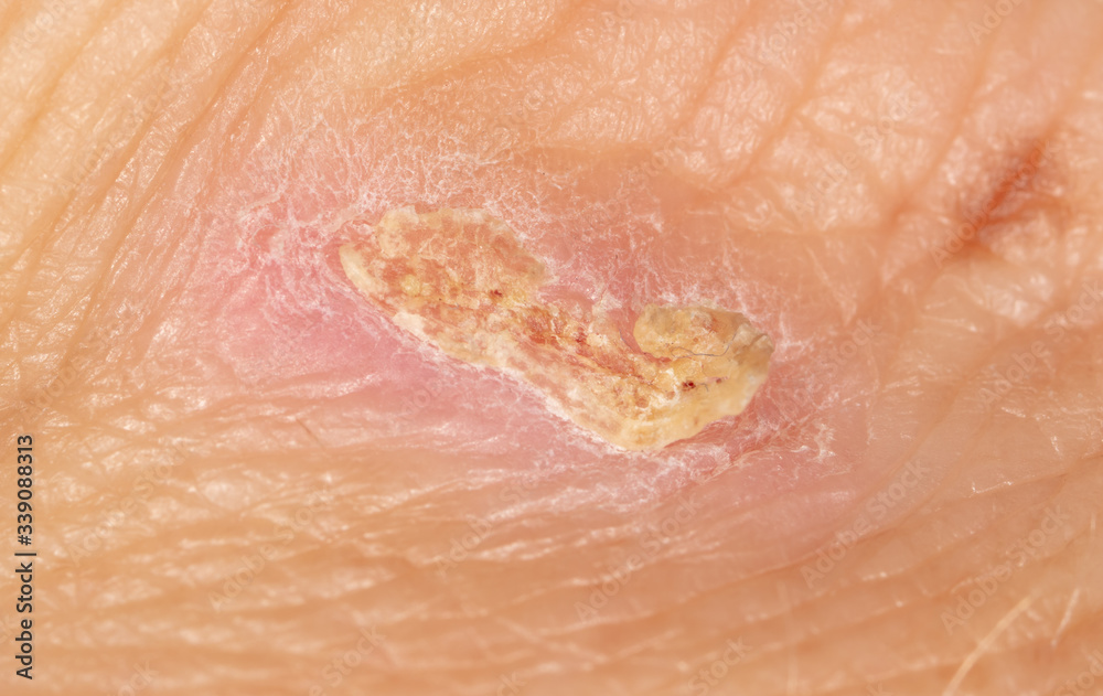 Fototapeta premium A wound from a knife cut on a person’s skin