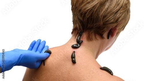 Tableau sur toile Blood sucking leechs hirudo medicinalis on woman's head and shoulders