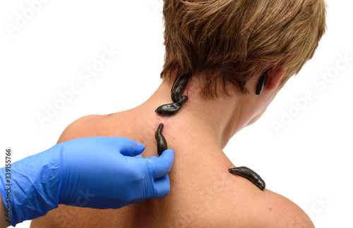 Фотография Blood sucking leechs hirudo medicinalis on woman's head and shoulders