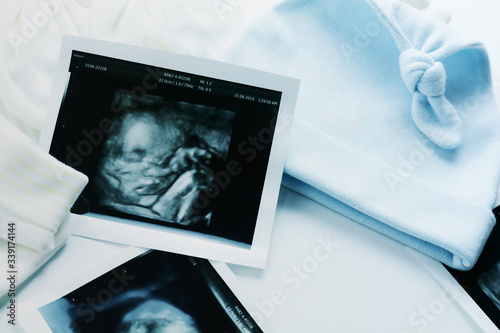 3d/4d ultrasound film show baby boy in womb 6 month on white back ground. Pregnancy concept.