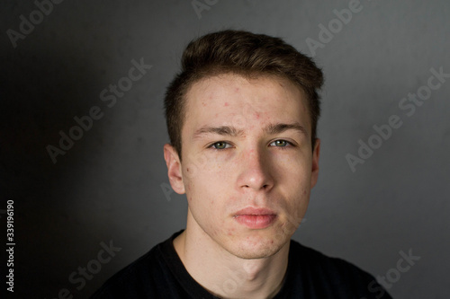 Young man struggling with acne on his face caring for his skin pushes acne