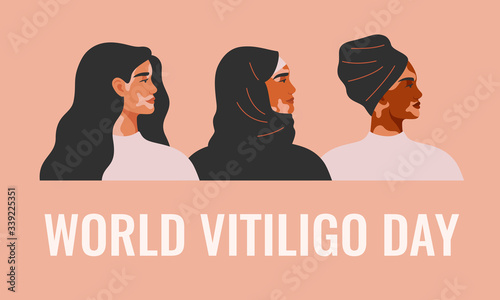 World Vitiligo day card with Three women with vitiligo of different nationalities standing together. Concept to support awareness about chronic skin disorder.Vector illustration
