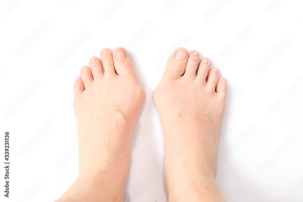 Hallux valgus, feet isolated on white. Hallux valgus is a medical term for bunion foot / bunionette. Hallox Valgus is normally caused by genetic and/or wearing too tight shoes & high heels. Hallux valgus, feet isolated on white. Hallux valgus is a medical term for bunion foot / bunionette. Hallox Valgus is normally caused by genetic and/or wearing too tight shoes & high heels.
