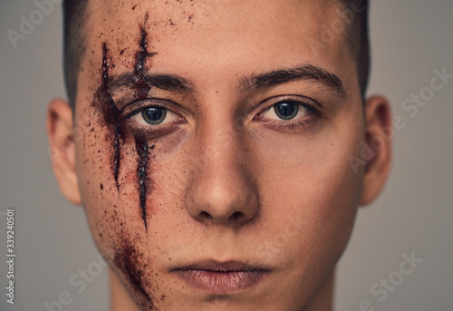 Teenage boy with wounds on face. Bullying and harassment.
