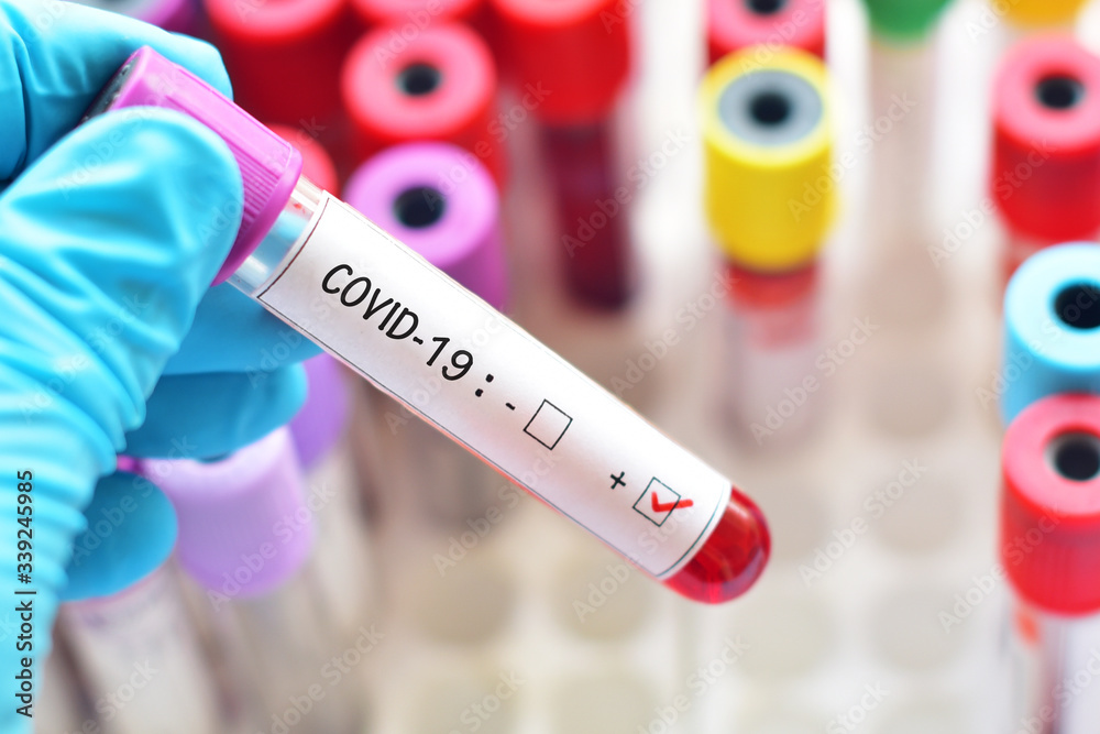 Obraz premium Blood sample tube positive with COVID-19 virus 