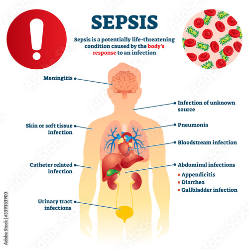 Sepsis vector illustration. Labeled infection condition educational scheme. photo