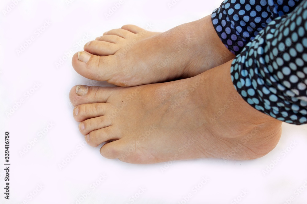 Fungus on the toenail. Dry, damaged toe nails. Woman's issues. Fungus of foot close-up, isolated on white background. The concept dermatology, treatment fungal and fungal infections in humans.