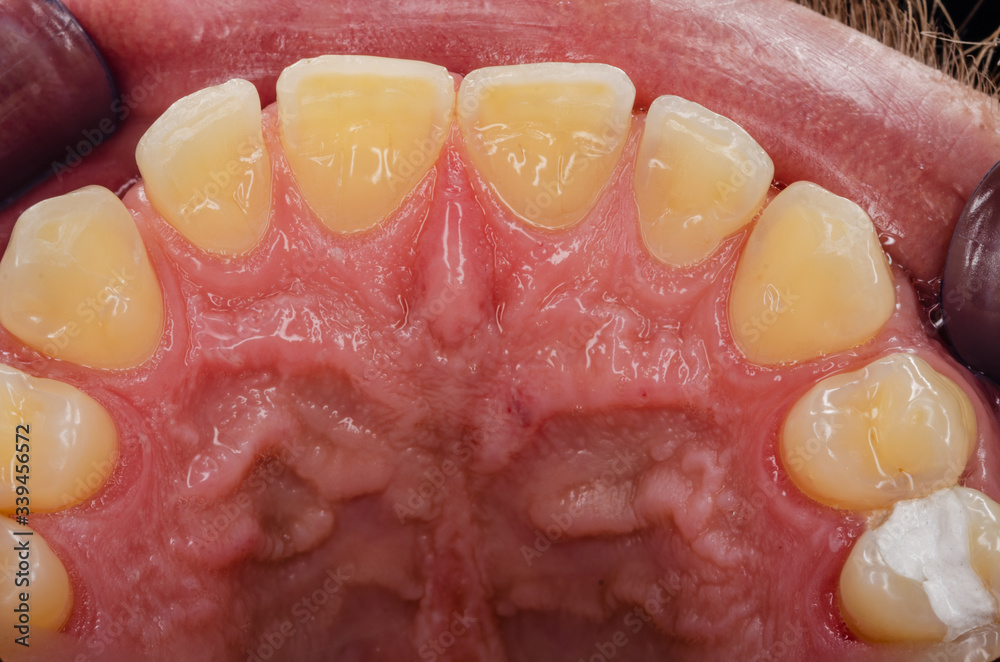 signs of teeth grinding on upper incisors