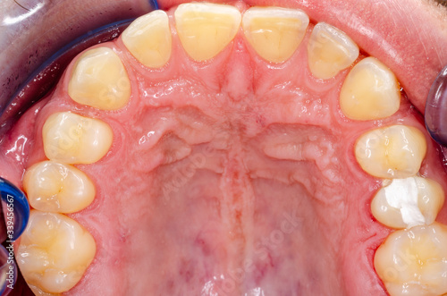 signs of teeth grinding on upper incisors