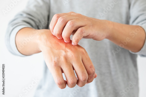Print op canvas Young asian man itching and scratching on hand from itchy dry skin eczema dermat