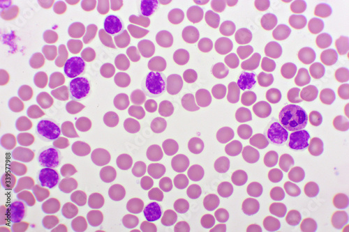 Picture of acute lymphocytic leukemia or ALL cells in blood smear, analyze by microscope, 1000x