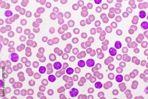 Picture of acute lymphocytic leukemia or ALL cells in blood smear, analyze by microscope, 1000x