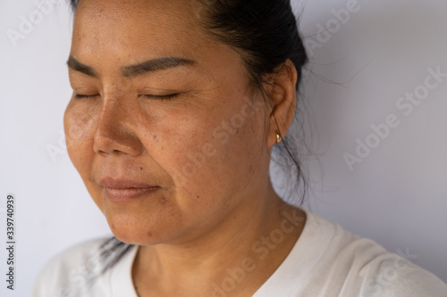 An Asian woman with the Nasolabial folds (cheeks lines) and skin problem such as wrinkles and dark spots on her face.