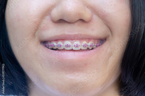 Asian teenager smiling with pink braces on teeth
