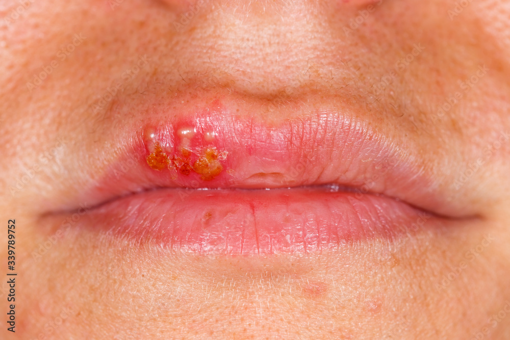 Obraz premium Oral herpes simplex virus infection