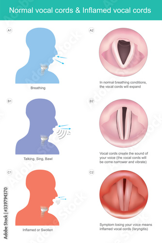 Normal vocal cords & Inflamed vocal cords. The vocal cords create the sound of your voice for speaking or sing, if losing your voice means vocal cords inflamed symptom..