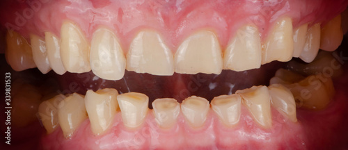 Photos The chipped and worn teeth