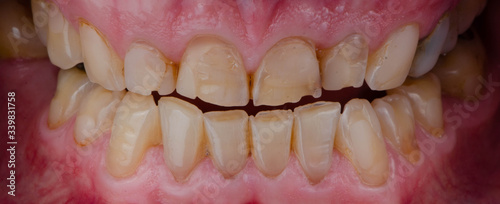 Fotografie, Obraz the broken and worn teeth